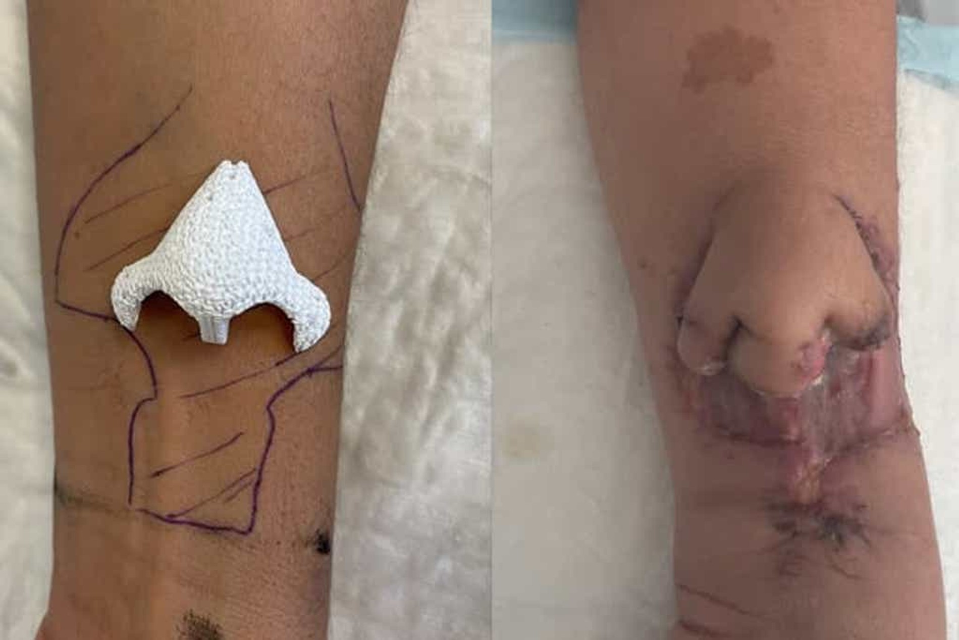 Процесс формирования нового носа на предплечье пациентки
Фото: CHU de Toulouse