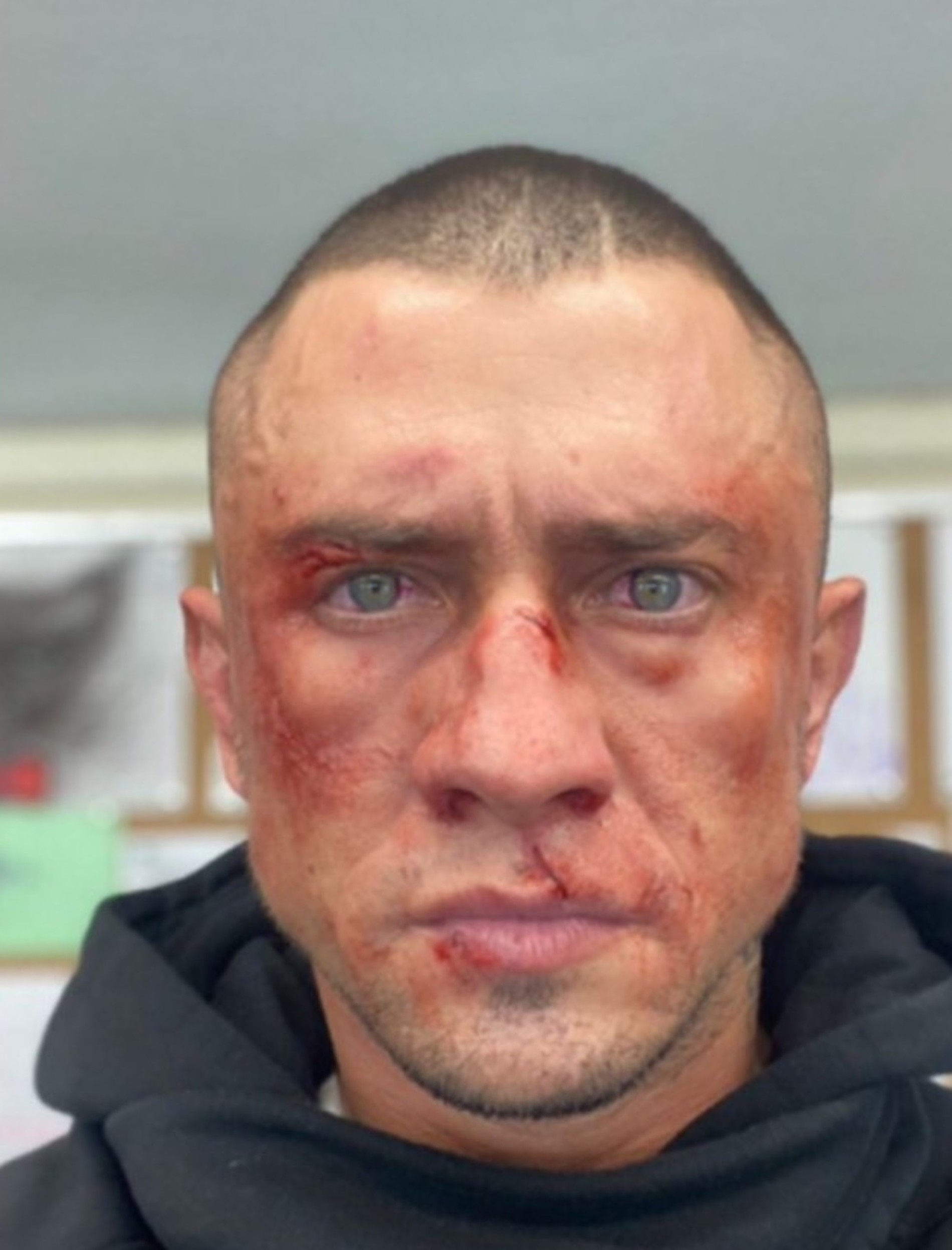 Павел Прилучный после инцидента в Калининграде
Фото: Инстаграм (запрещен в РФ)