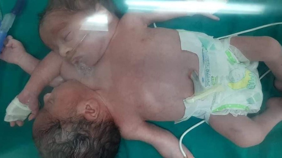 Сросшиеся близнецы, рожденные в Египте
Фото: Newsflash