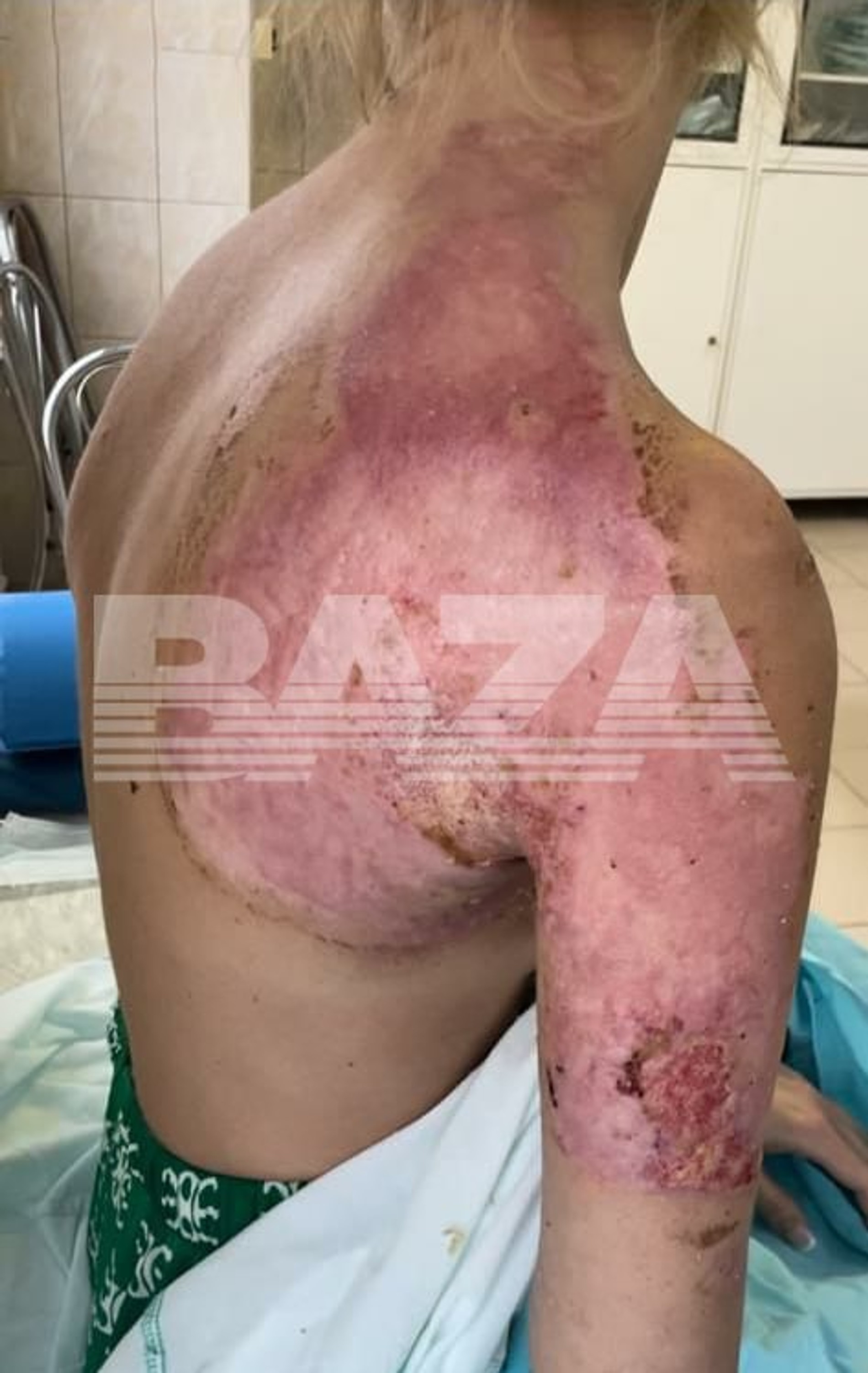 Девушка загорелась прямо на операционном столе: последствия
Фото: Baza