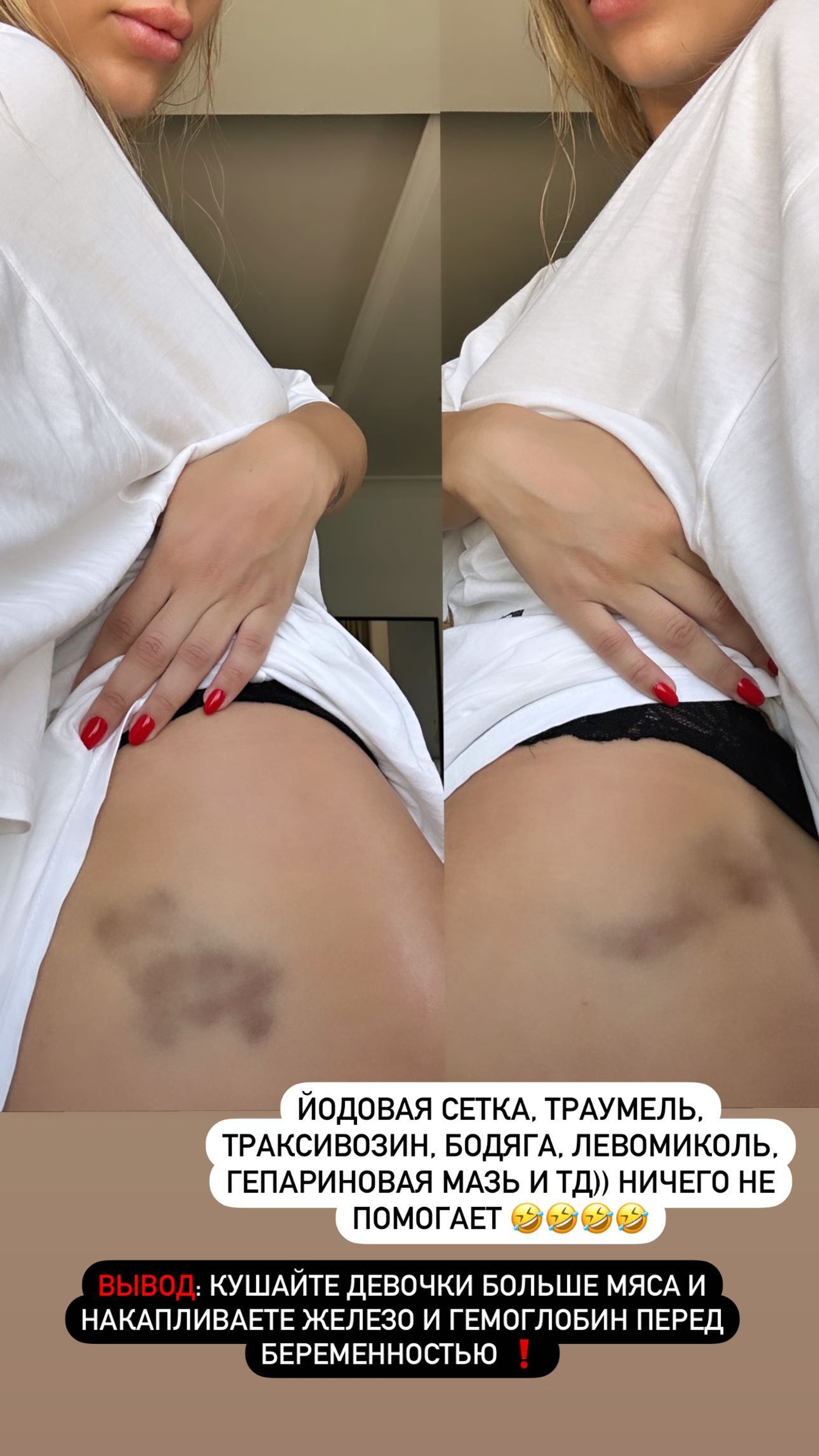 Ханна показала последствия уколов железа
Фото: Инстаграм (запрещен в РФ) / @offi_hanna