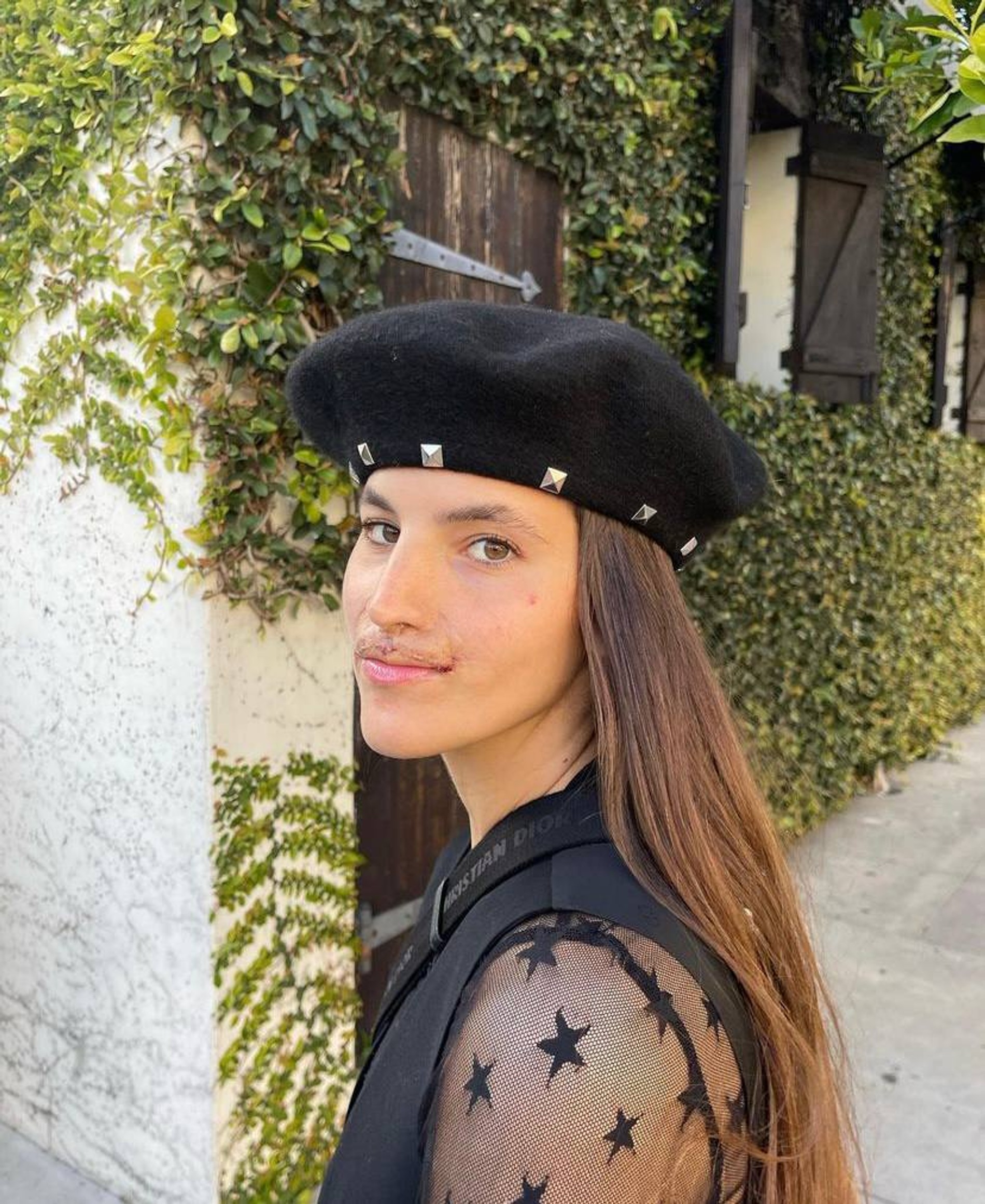 Бруклинн Хури спустя две недели после финальной операции по реконструкции губы
Фото: Инстаграм (запрещен в РФ) @brookhoury