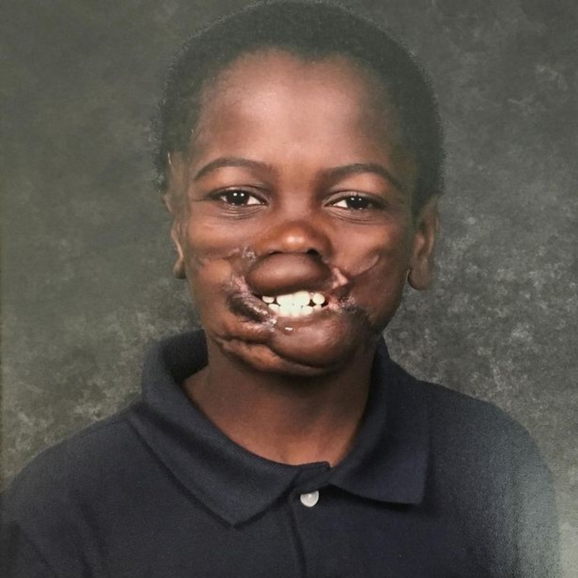 Дуния Сибомана после операций
Фото: Инстаграм (запрещен в РФ)