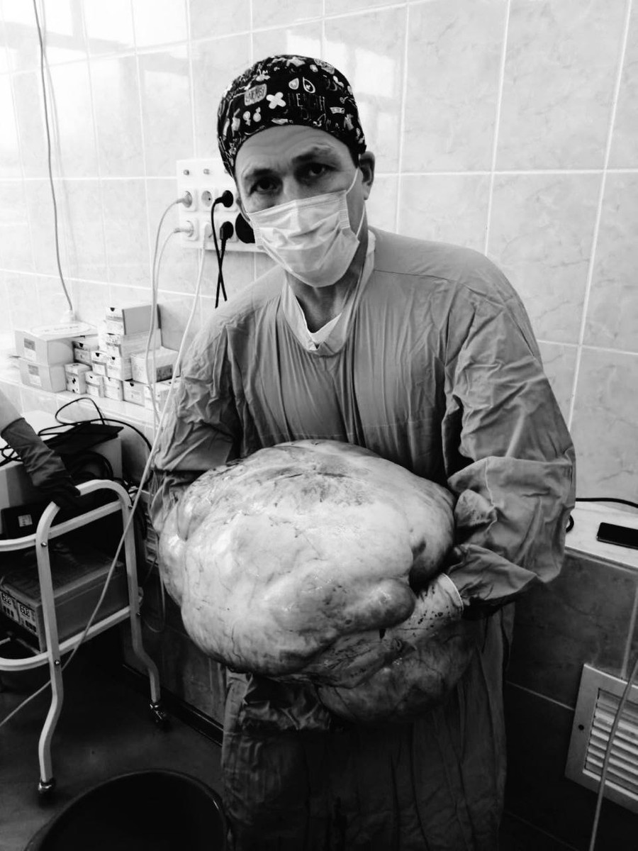 45-килограммовая опухоль, удаленная из брюшной полости 62-летней пациентки
Фото: Минздрав Московской области