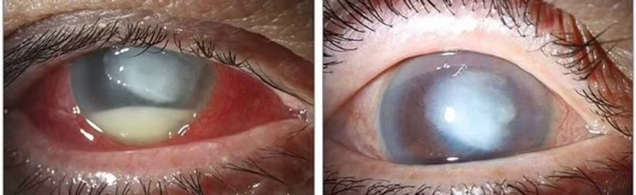 Фото зараженного глаза с применением щелевой лампы до и спустя месяц после лечения
Фото: Daily Mail 