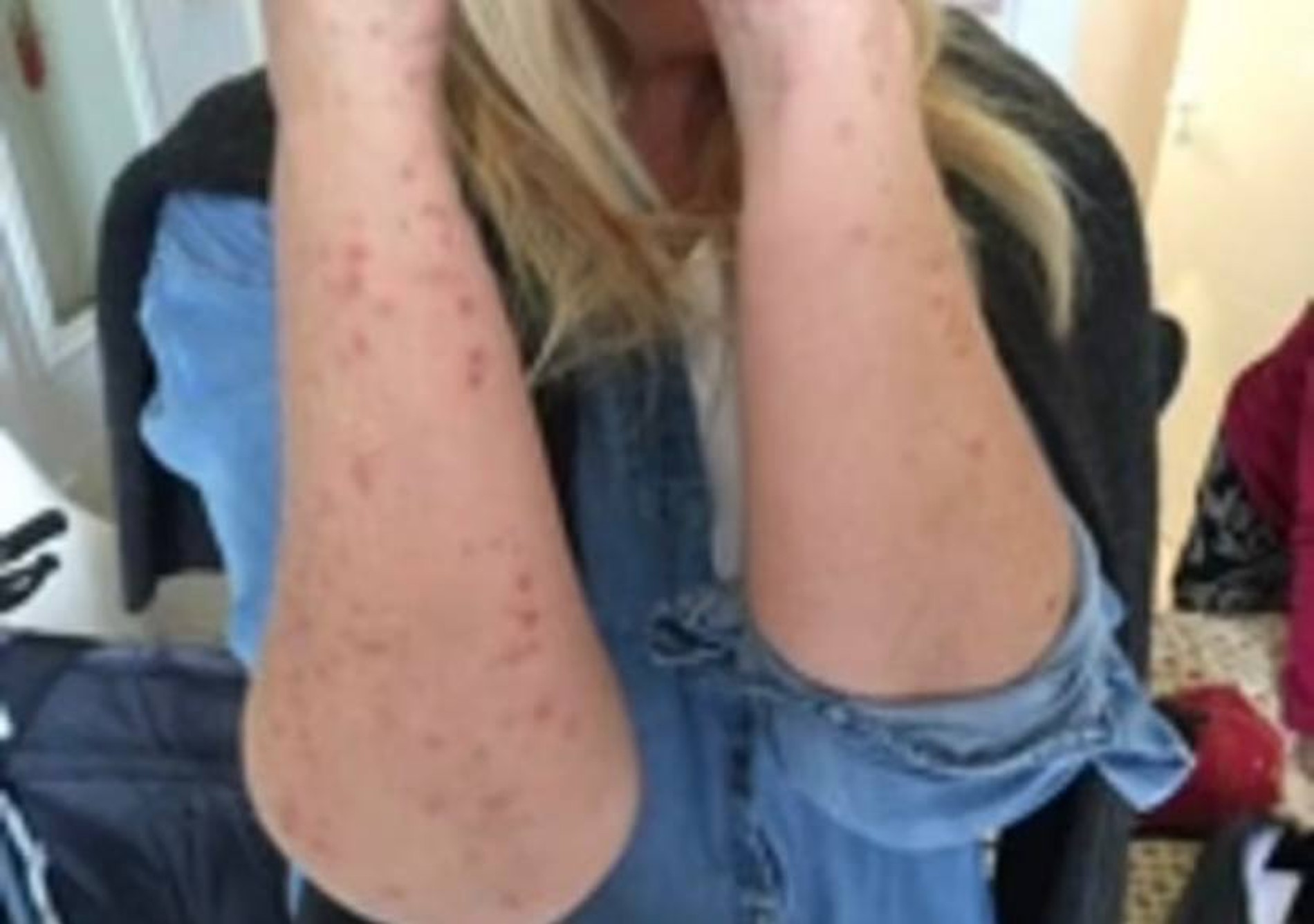 Укусы на теле Юты Тернер
Фото: Daily Mail