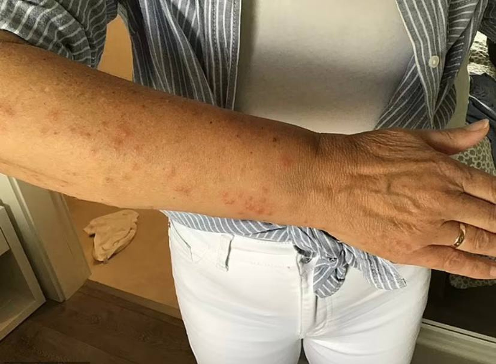 Укусы на теле Юты Тернер
Фото: Daily Mail