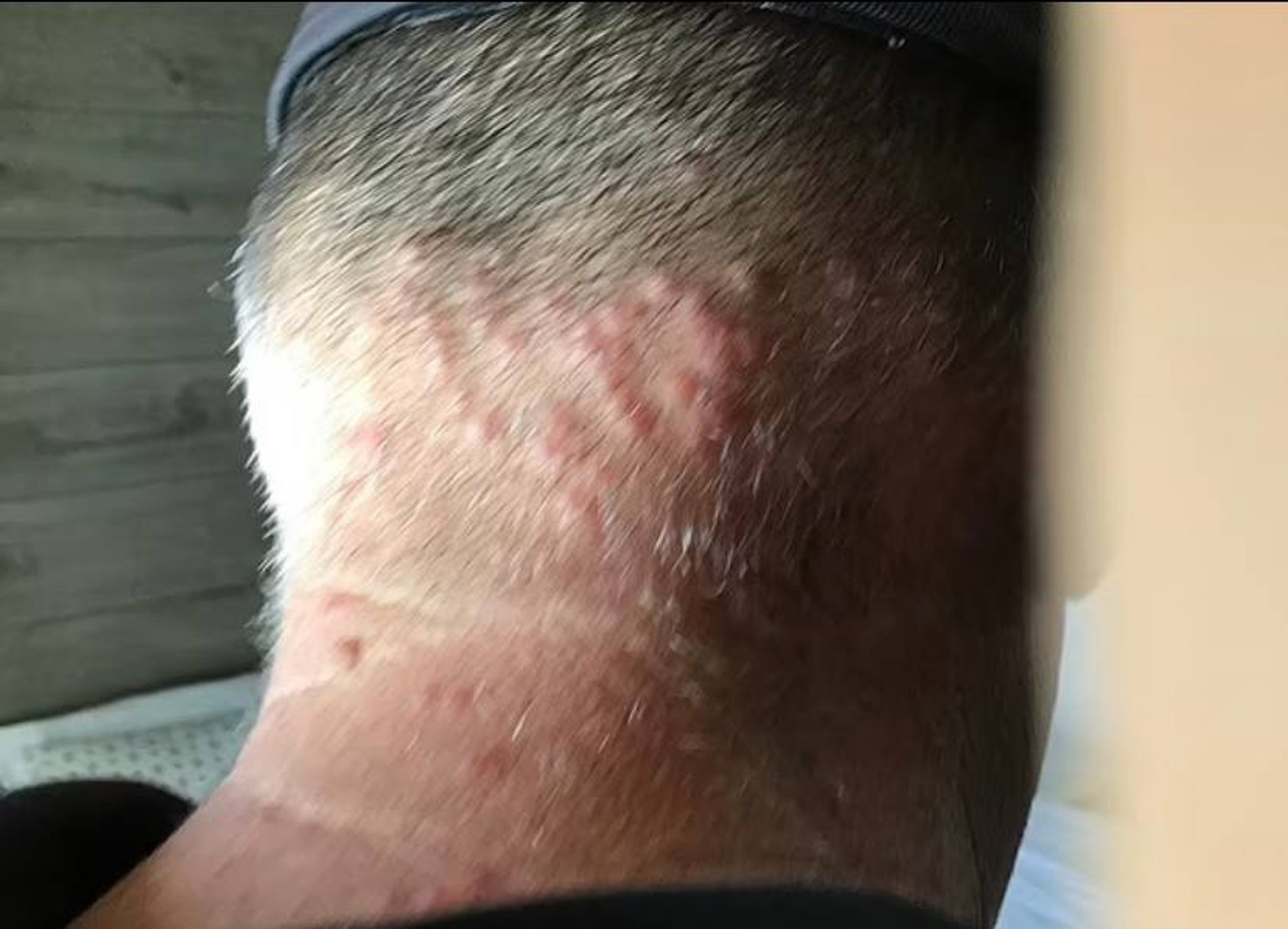 Затылок Гарри Тернера после ночевки в злополучном номере
Фото: Daily Mail