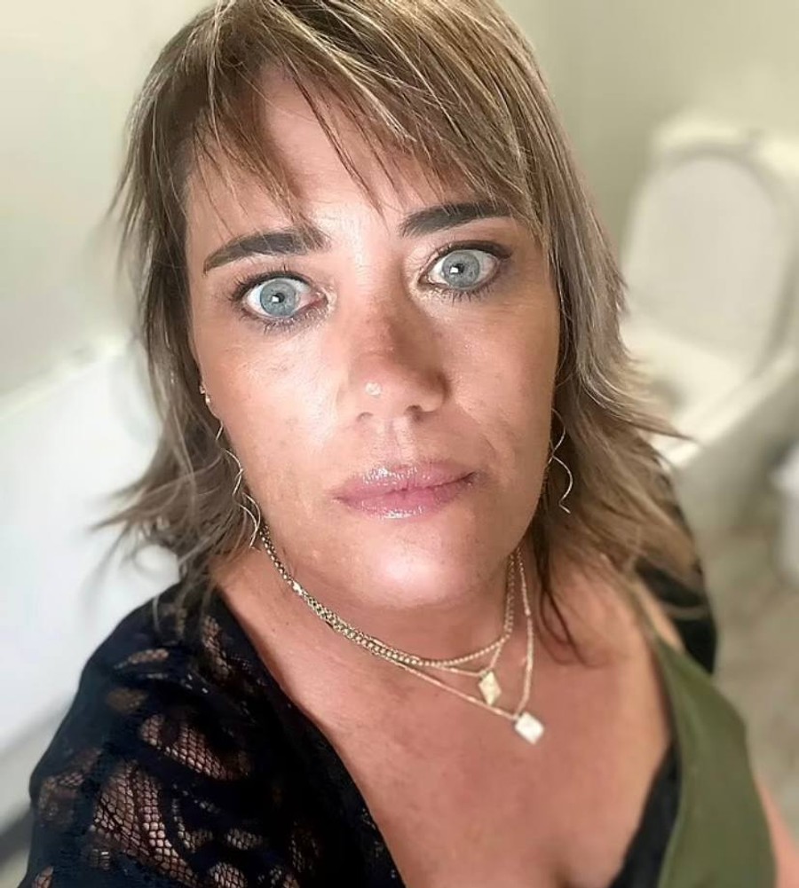 Мишель Дэвис несколько месяцев замазывала воспаление консилером
Фото: Daily Mail