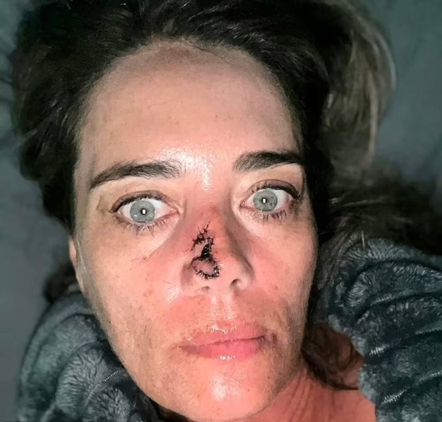 Мишель Дэвис после операции
Фото: Daily Mail