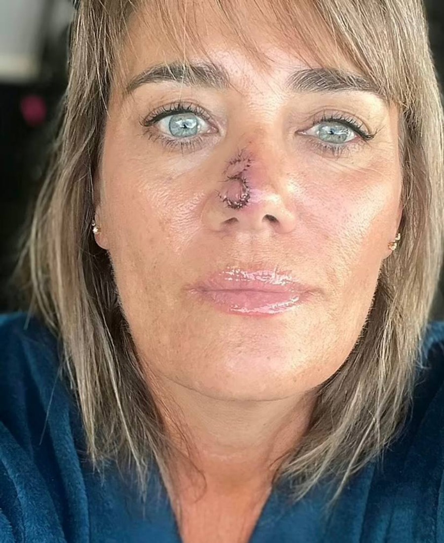 Мишель Дэвис после операции
Фото: Daily Mail