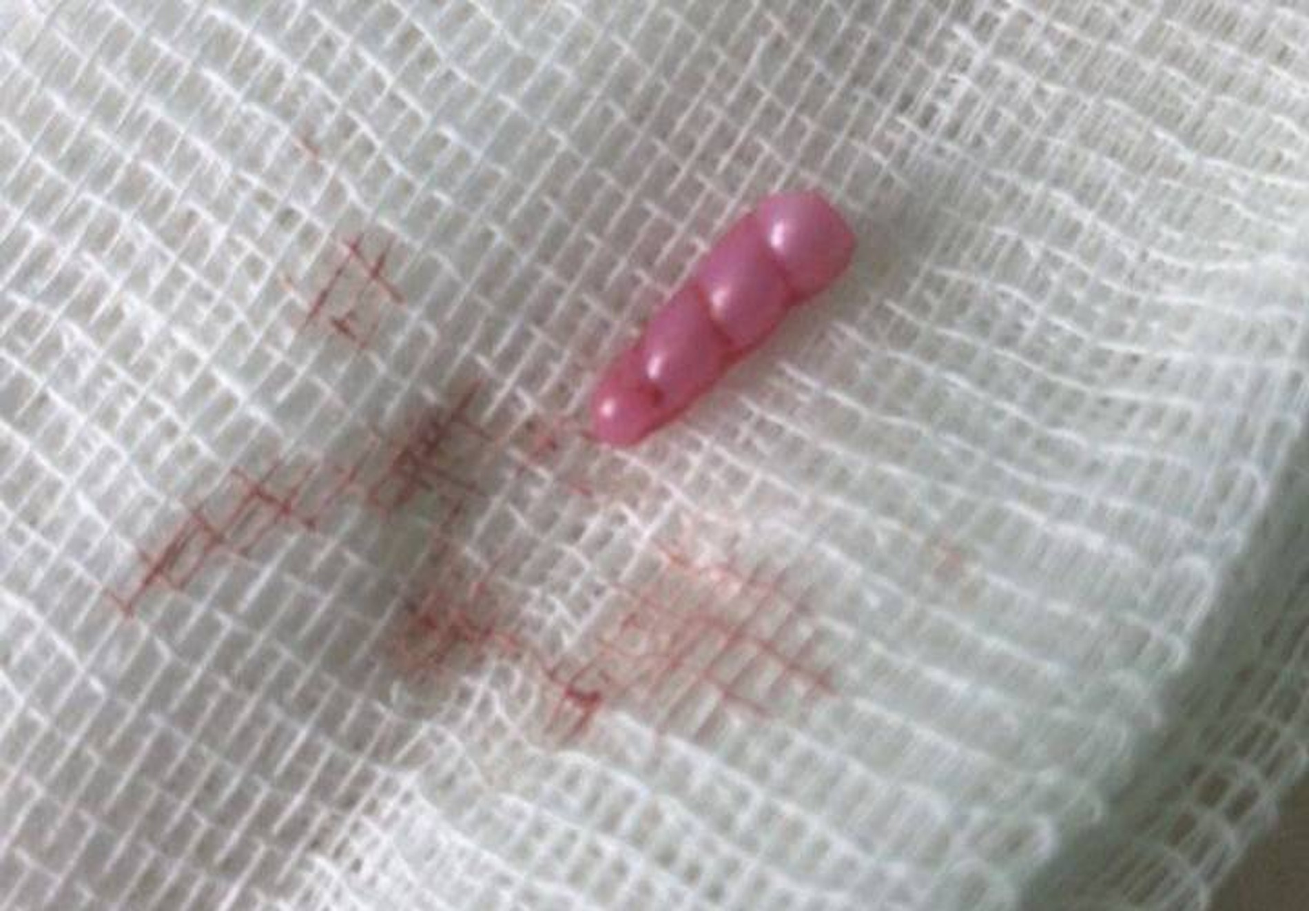 Рог игрушечного единорога, который врачи извлекли изо лба ребенка
Фото: Life