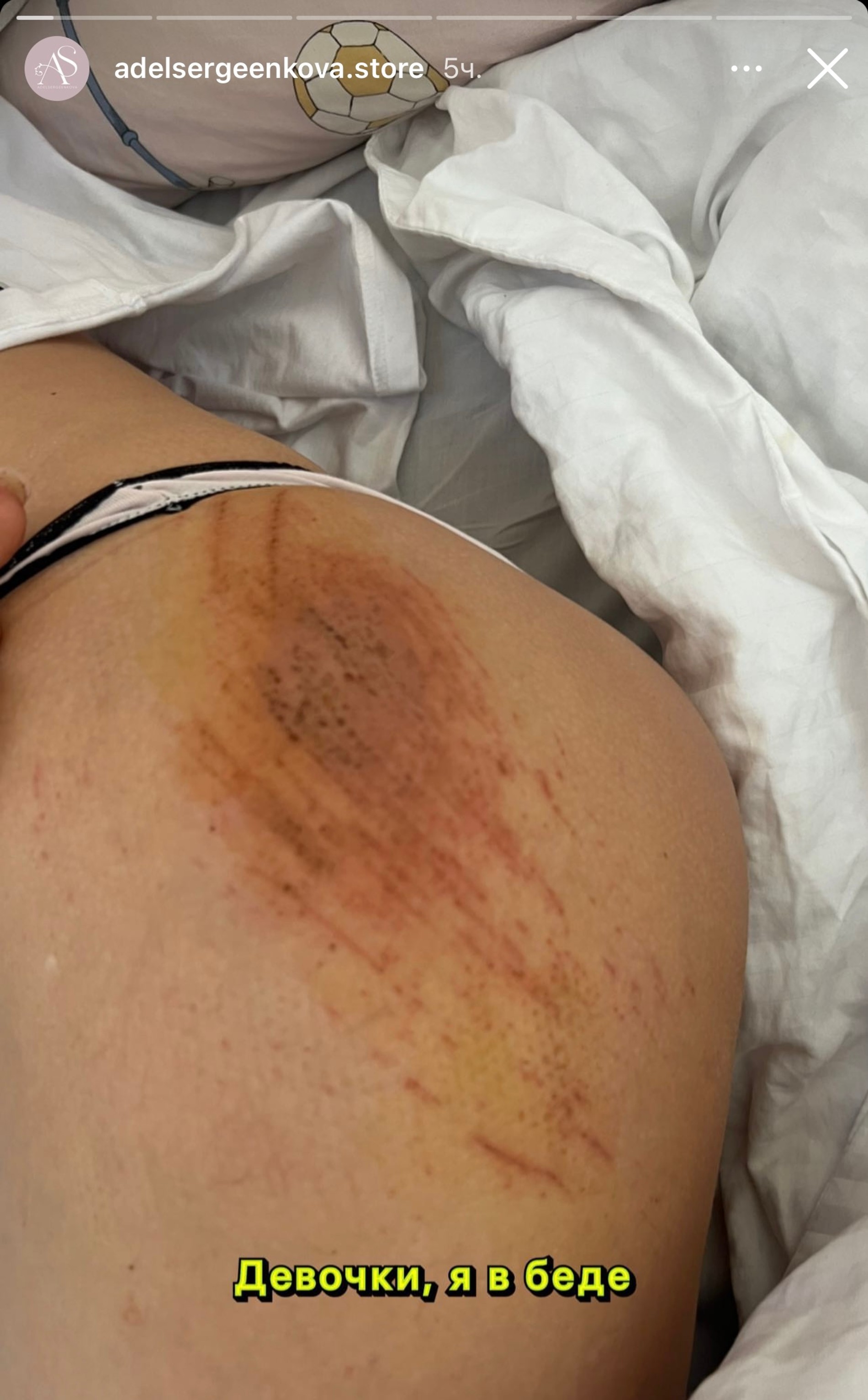 Адель Сергеенкова после аварии
Фото: Инстаграм (запрещен в РФ) @adelsergeenkova.store