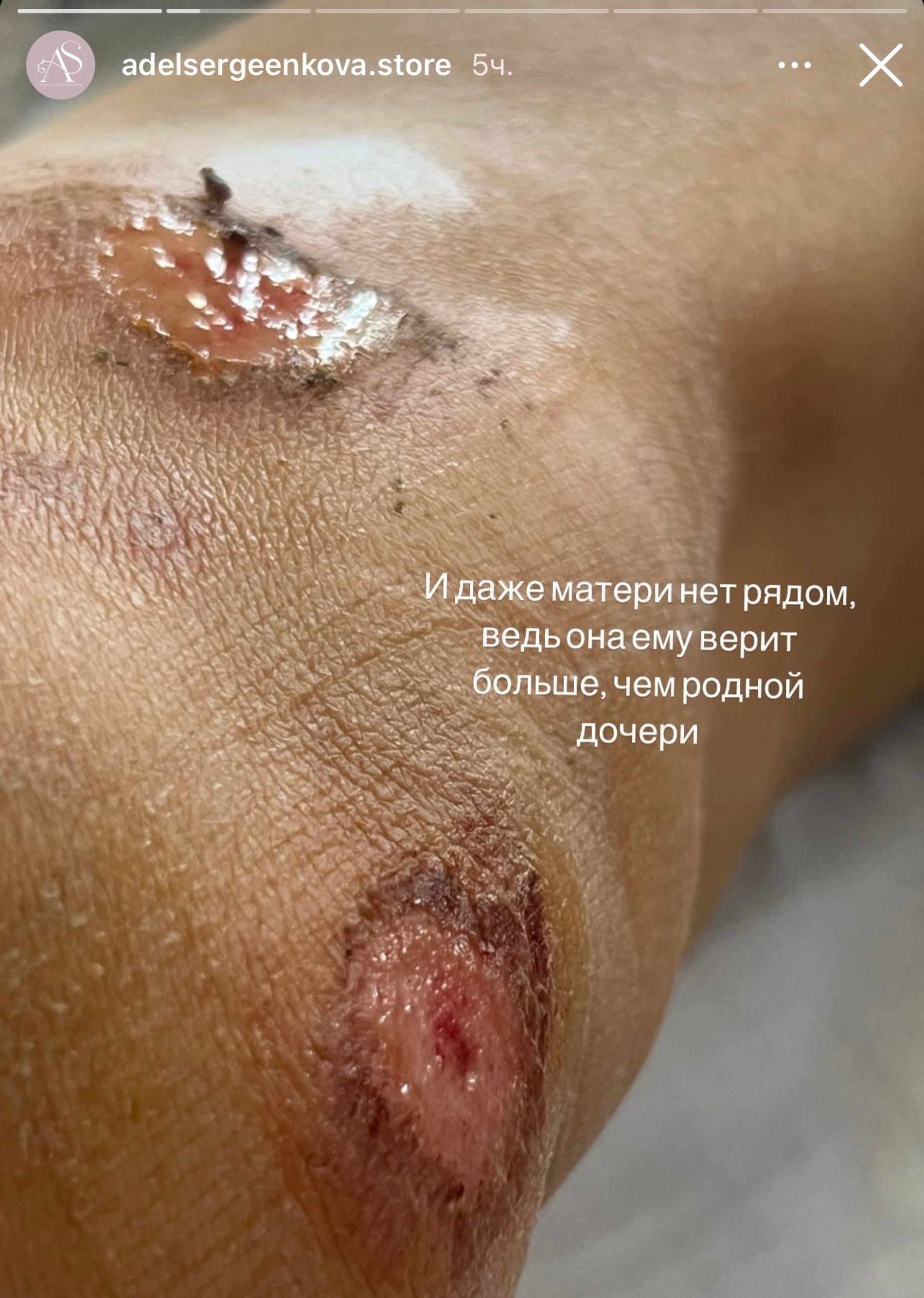 Адель Сергеенкова после аварии
Фото: Инстаграм (запрещен в РФ) @adelsergeenkova.store