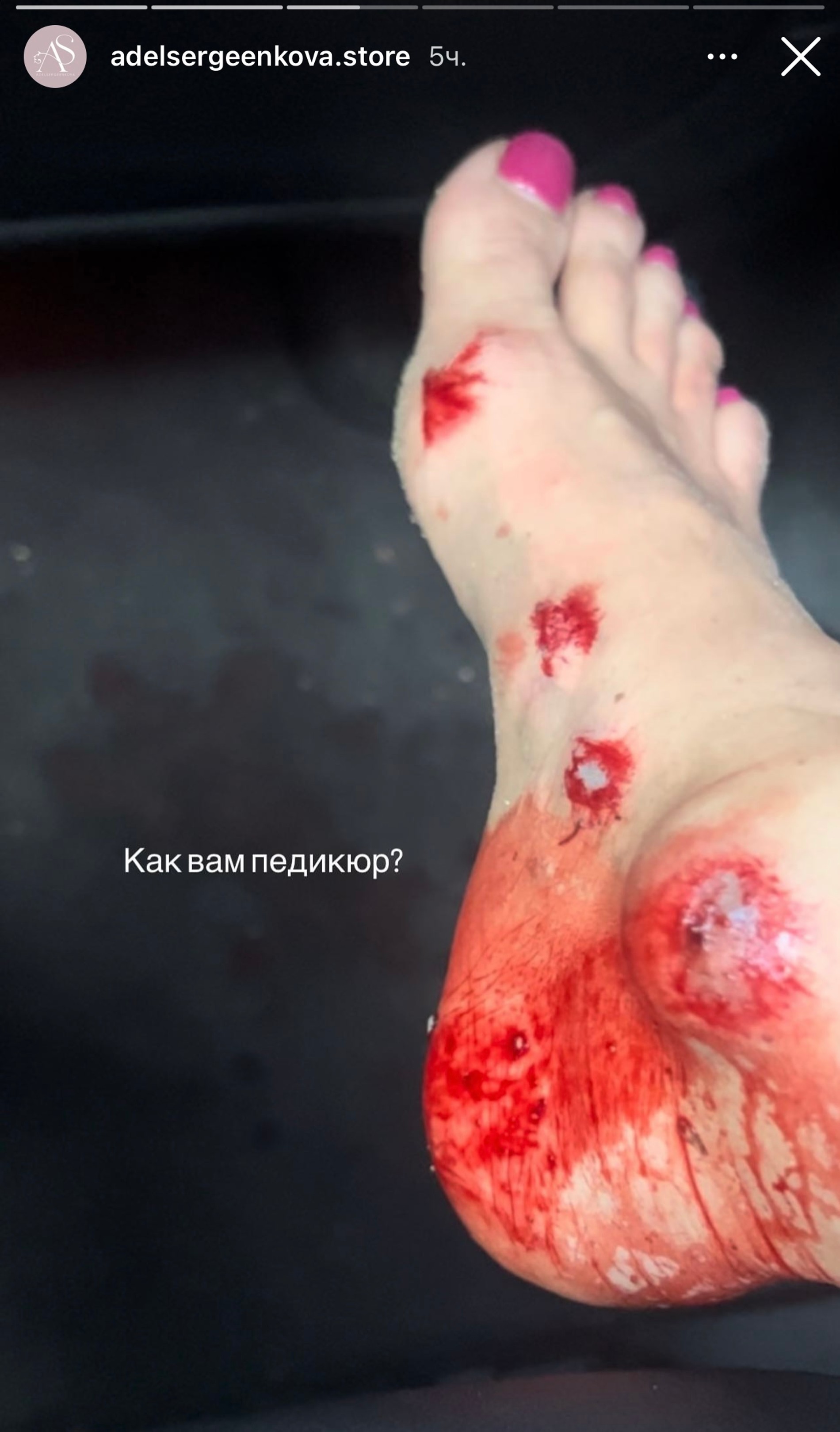 Адель Сергеенкова после аварии
Фото: Инстаграм (запрещен в РФ) @adelsergeenkova.store