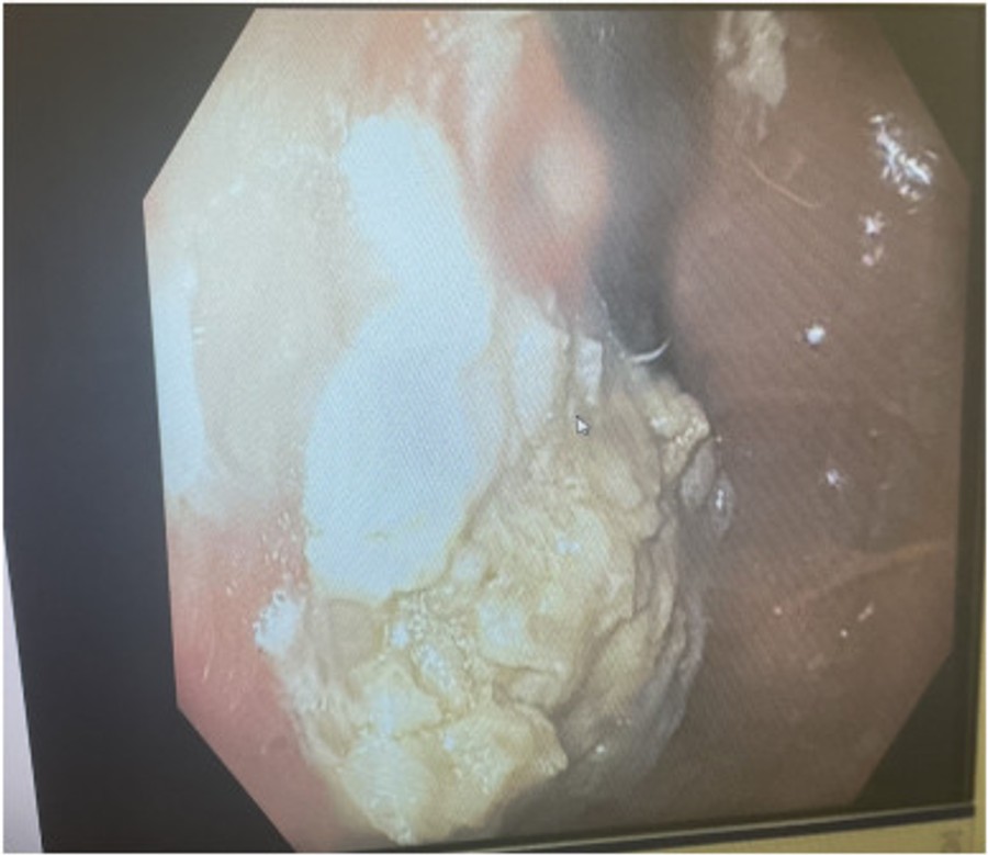 Снимок желудка мальчика, который проглотил 40 жвачек
Фото: Science Direct
