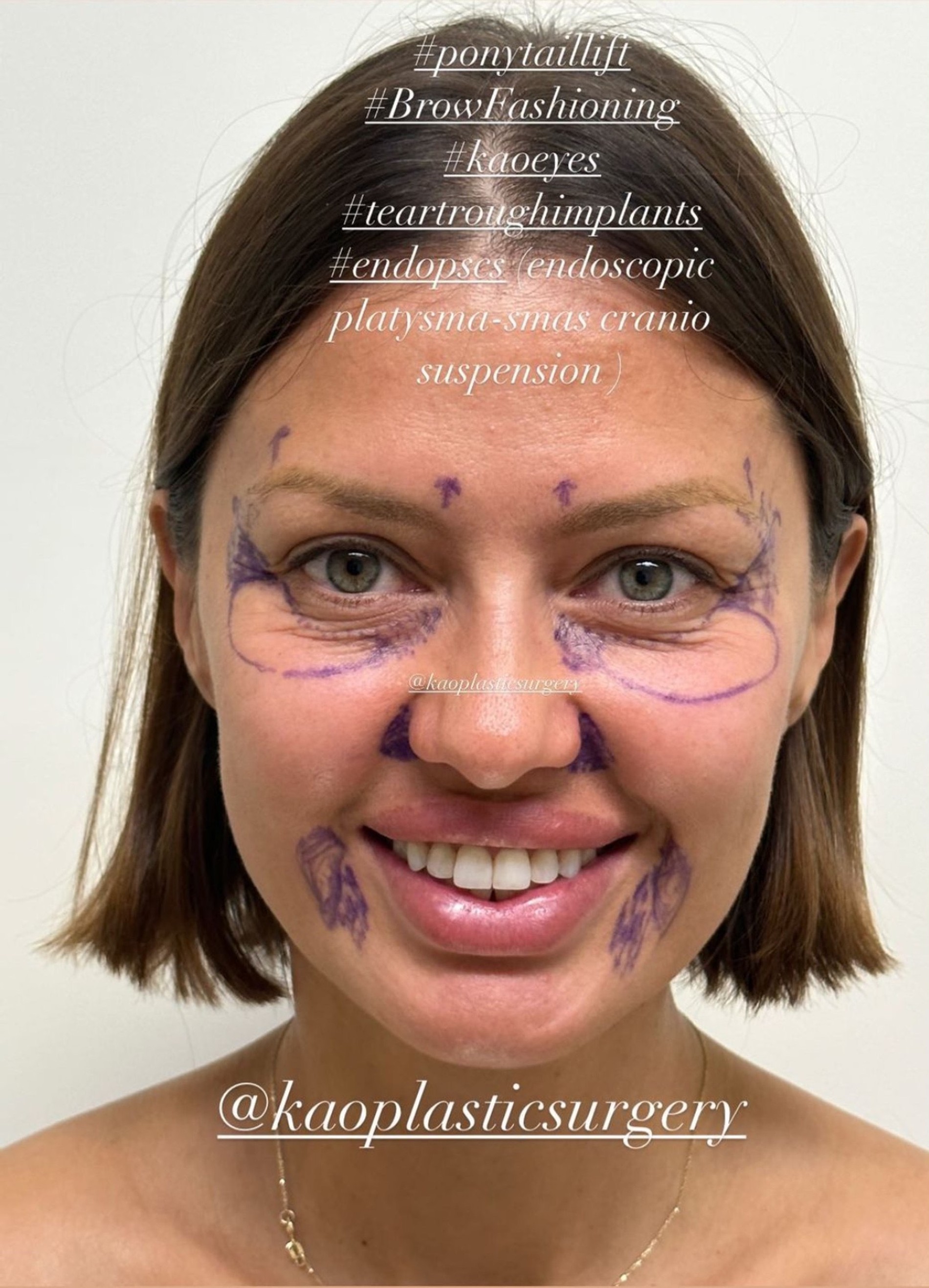 Виктория Боня перед операцией. Фото: Инстаграм* @kaoplasticsurgery