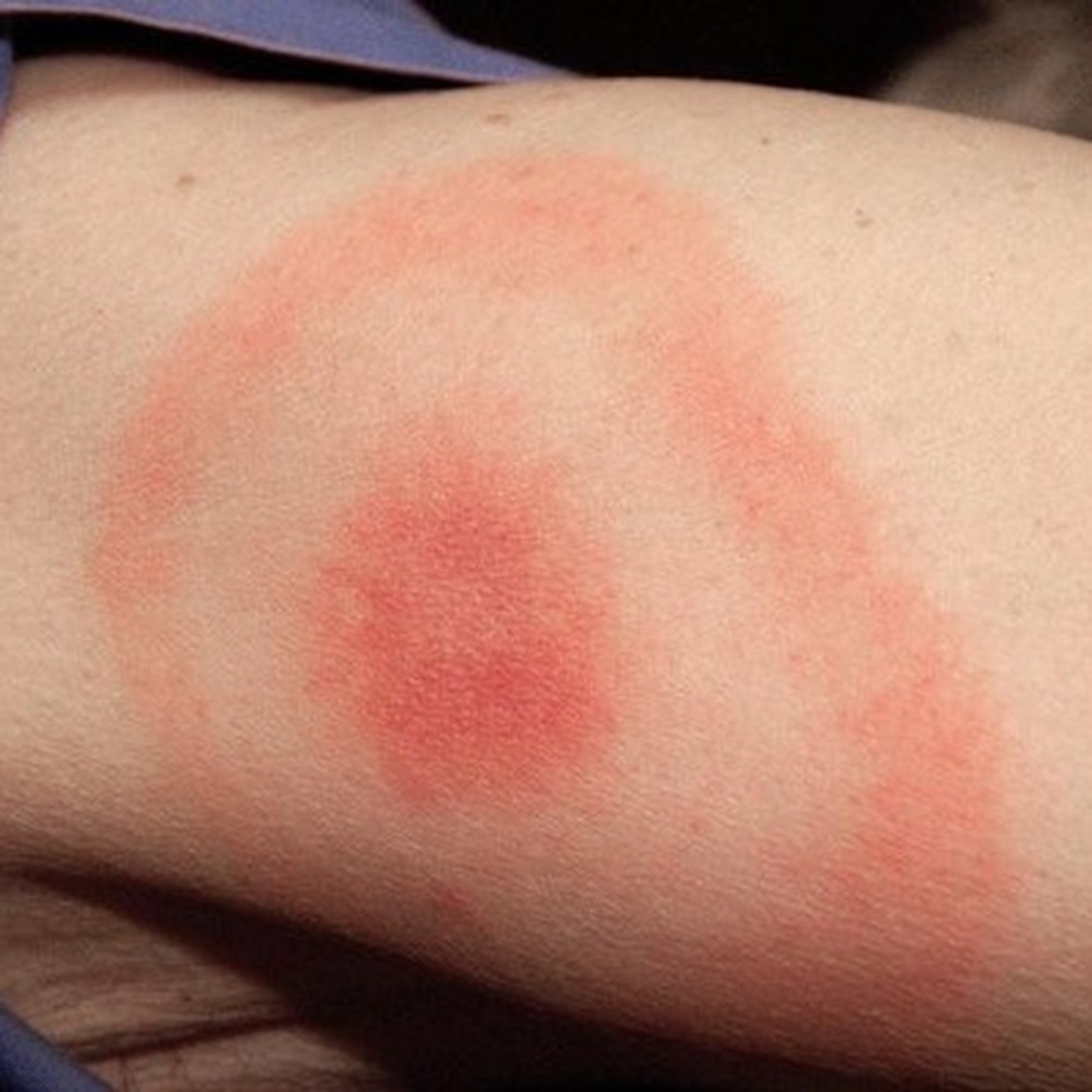 Эритема. Фото: Социальные сети