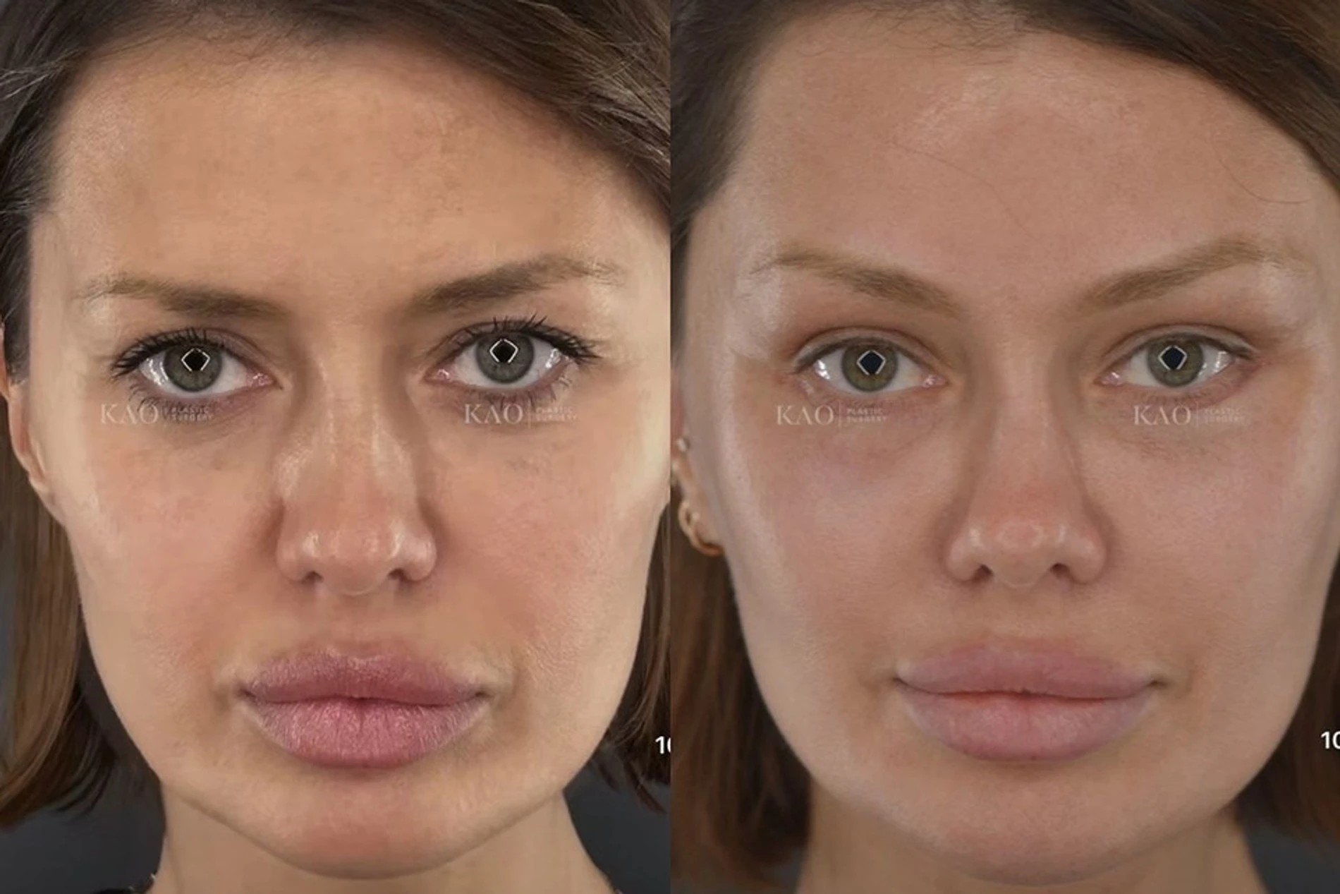 Виктория Боня до и после пластический операции. Фото: Инстаграм* @kaoplasticsurgery