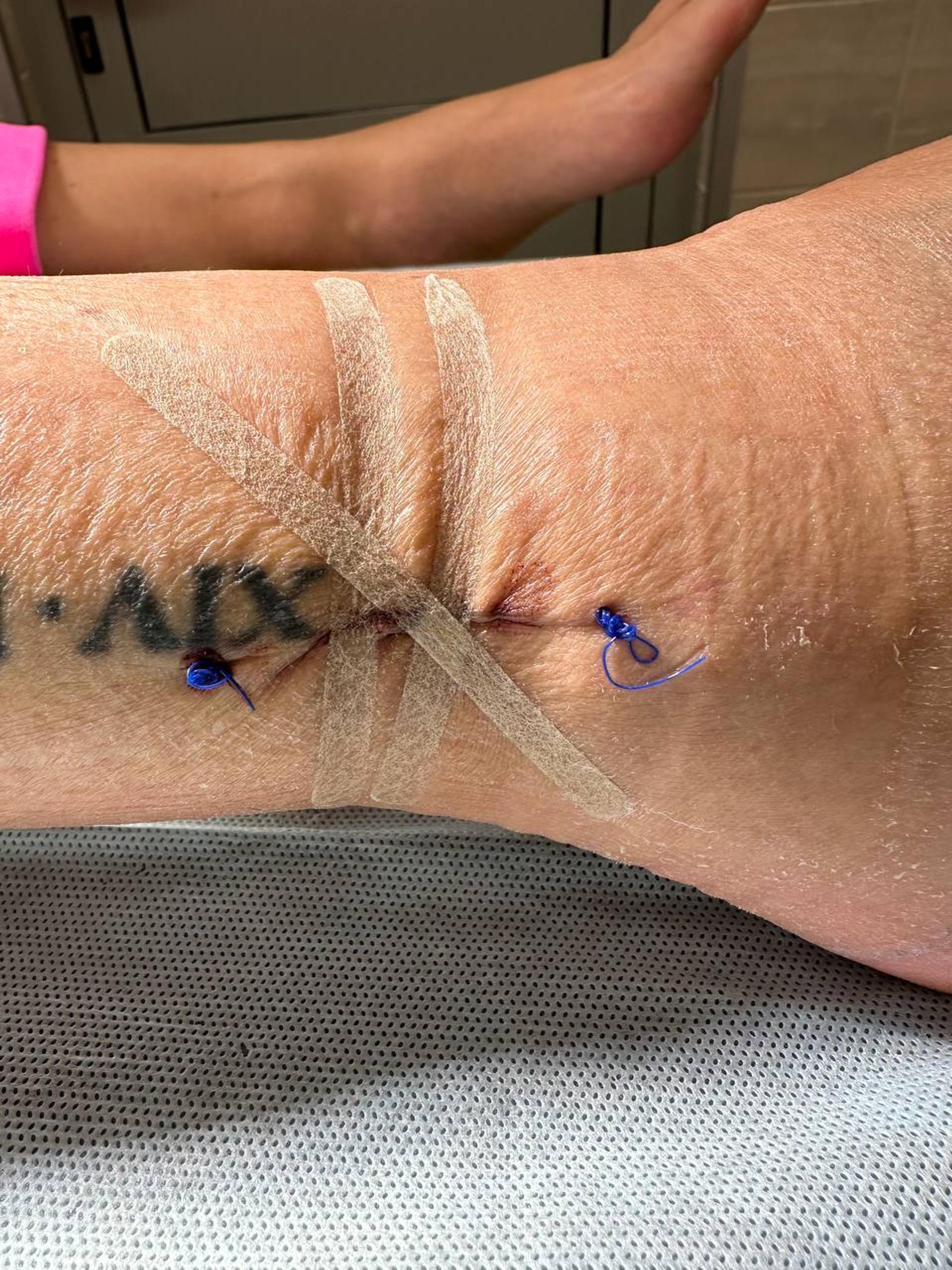 Место, откуда взяли вырезали сухожилие для трансплантации.  Фото: телеграм-канал @lerakudryavtseva