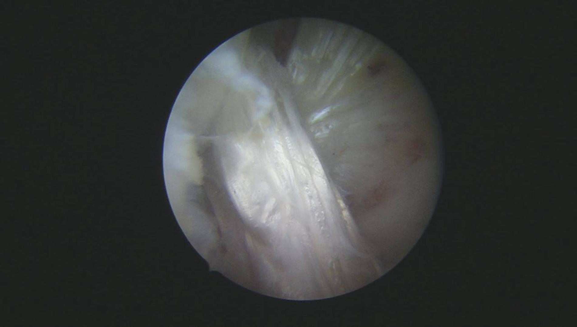 Трансплантат внутри ноги Леры Кудрявцевой. Фото: телеграм-канал @lerakudryavtseva