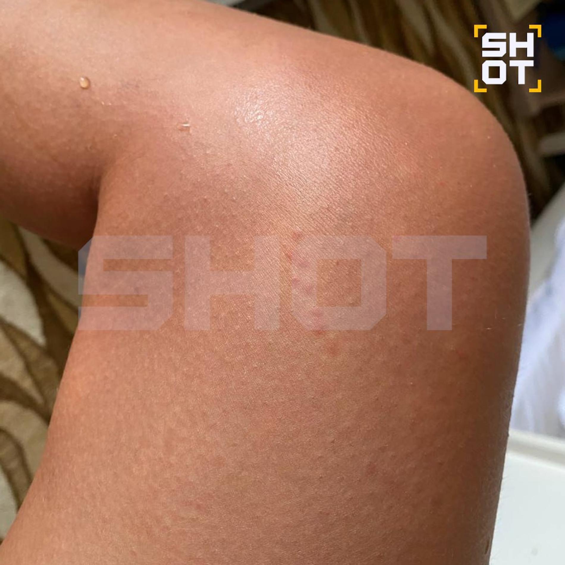 Ожоги от медуз у туристов в Турции. Фото: Telegram @shot_shot