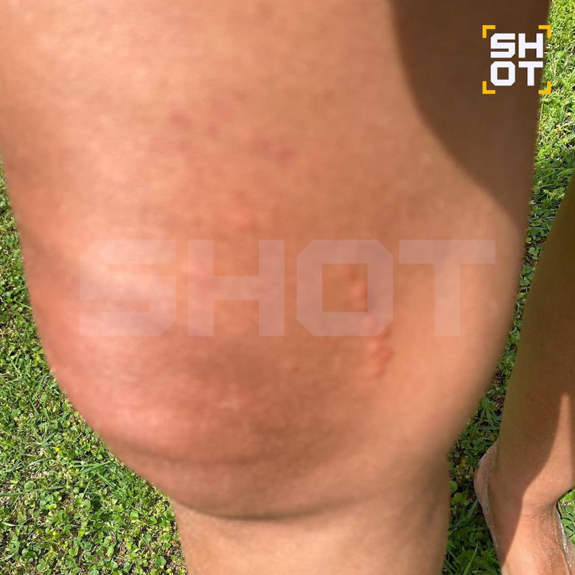 Ожоги от медуз у туристов в Турции. Фото: Telegram @shot_shot